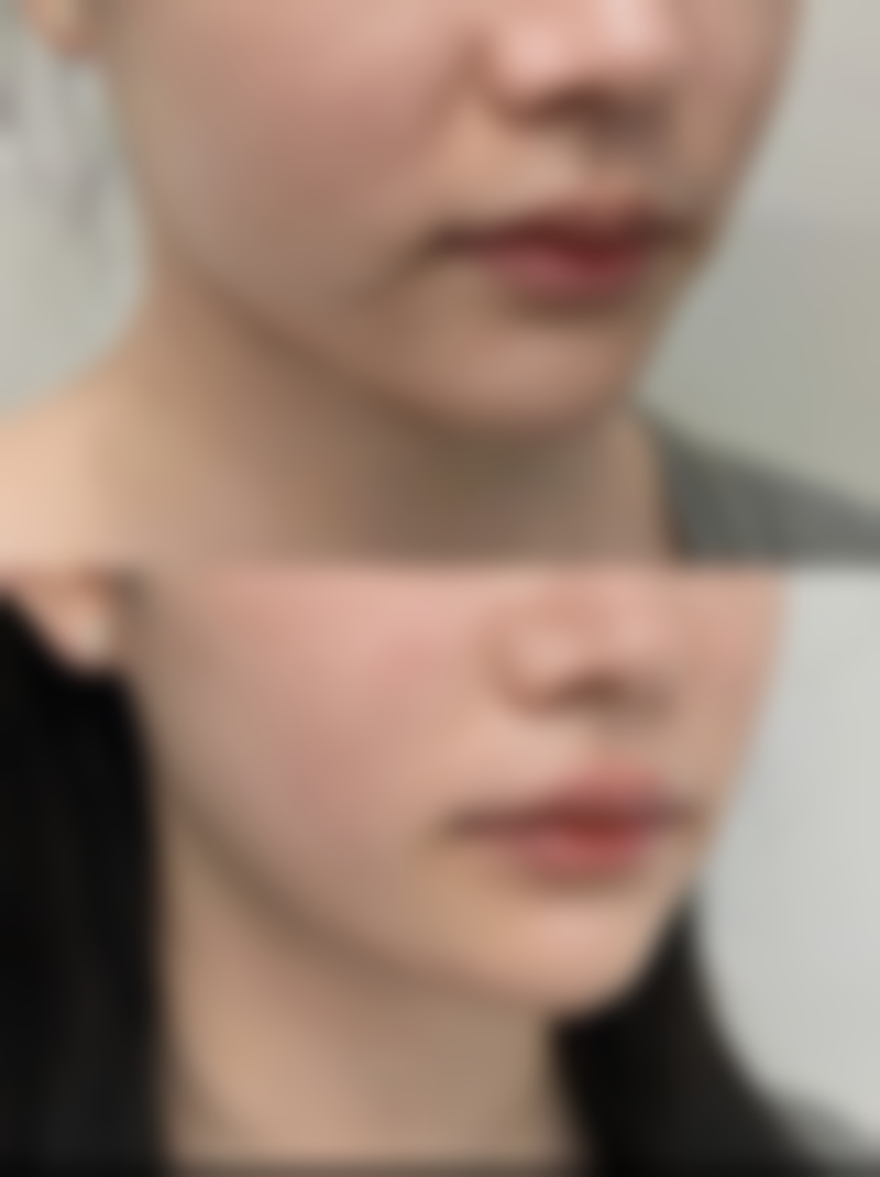 全切双眼皮四个半月可以修复吗？权威解答：此时修复正当时，助你快速拥有自然迷人双眸！ 