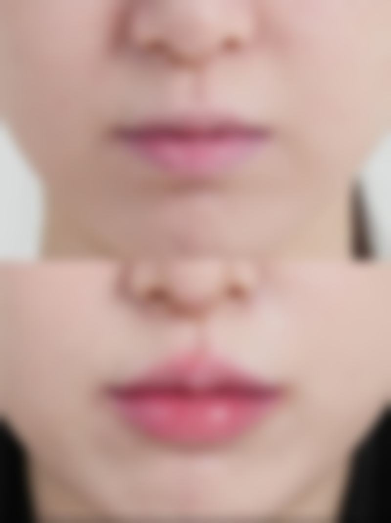 全切双眼皮四个半月修复有哪些注意事项