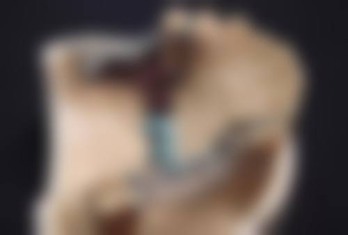 剖腹产疤痕增生厉害怎么治疗好