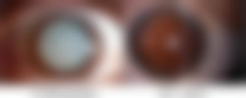 非疤痕体质疤痕增生的概率怎么样