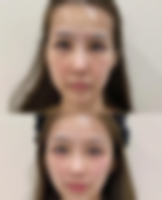 身体肥胖抽脂适合所有人吗