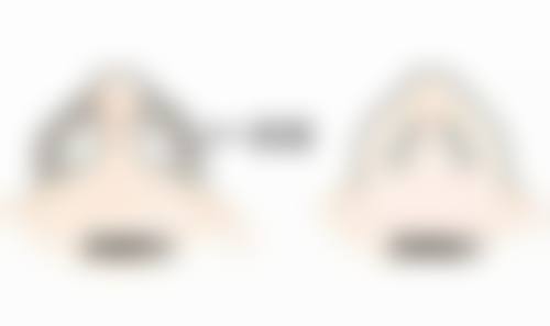 熬夜会导致眼袋突然水肿吗