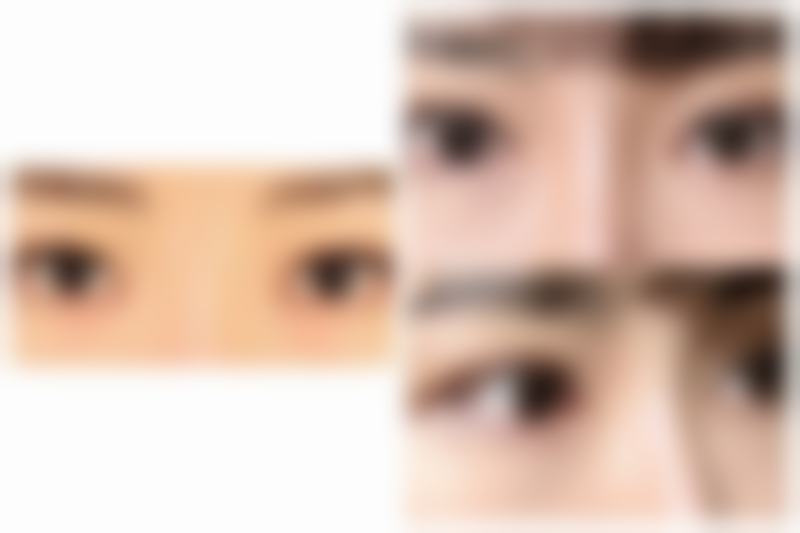 眼部感染会导致眼袋突然水肿吗