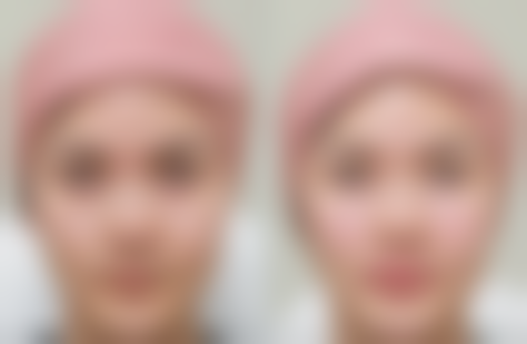 切眉后凹陷疤痕处理后如何护理