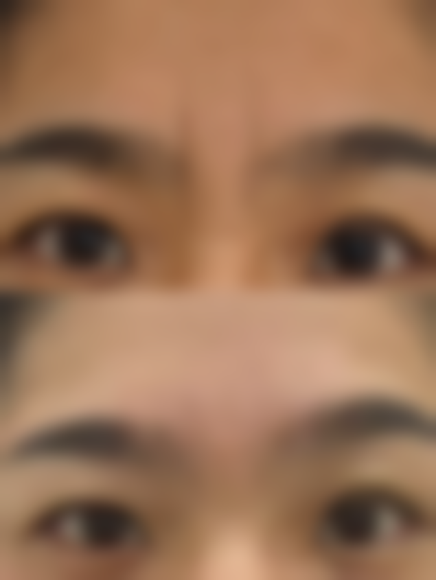 嗨体除皱副作用怎么样