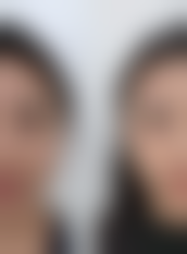 嗨体除皱副作用适合哪些人