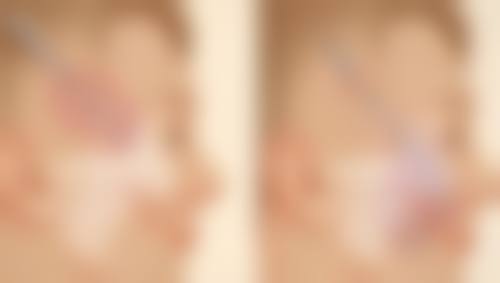 生物材料假体用于假体隆胸好不好