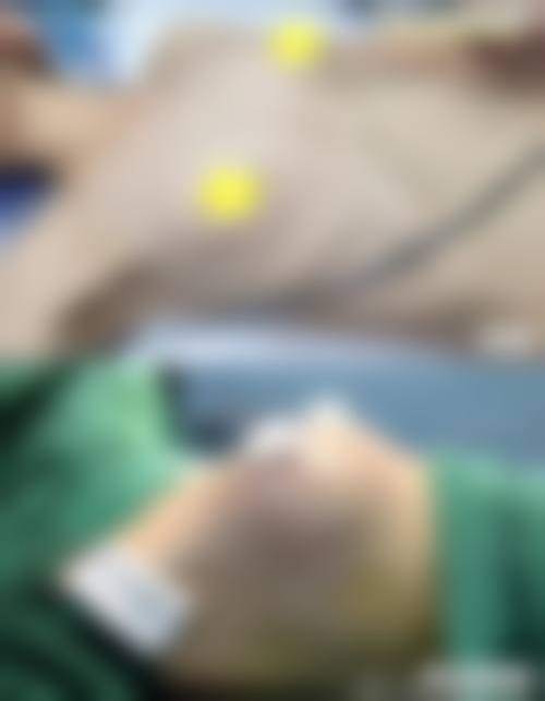 芜湖美人鱼医疗美容（陈伟中医疗美容）真实实例