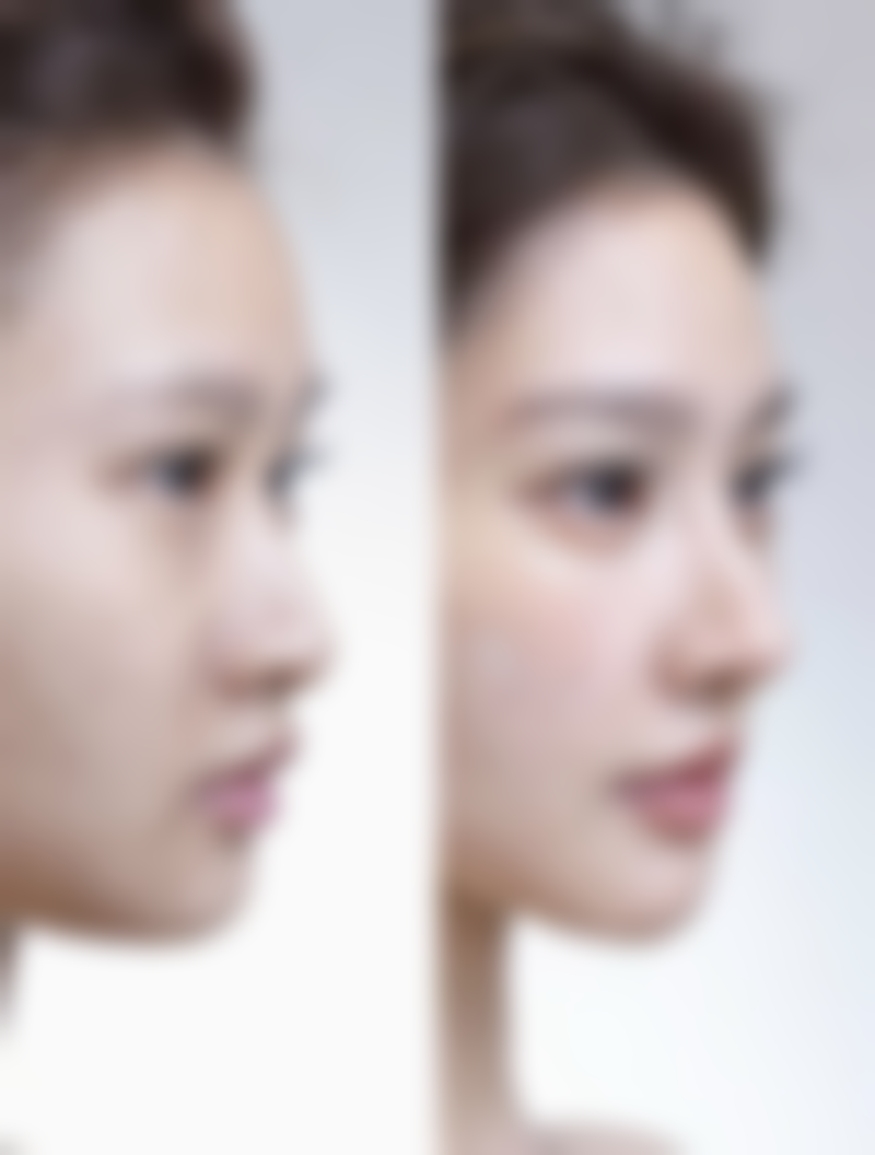 复合型假体用于假体隆胸值不值