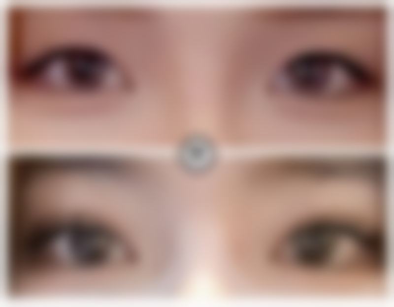 割双眼皮后伤口护理怎么样做才正确