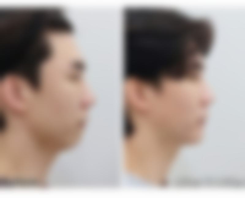 注射肉毒素除皱针值不值