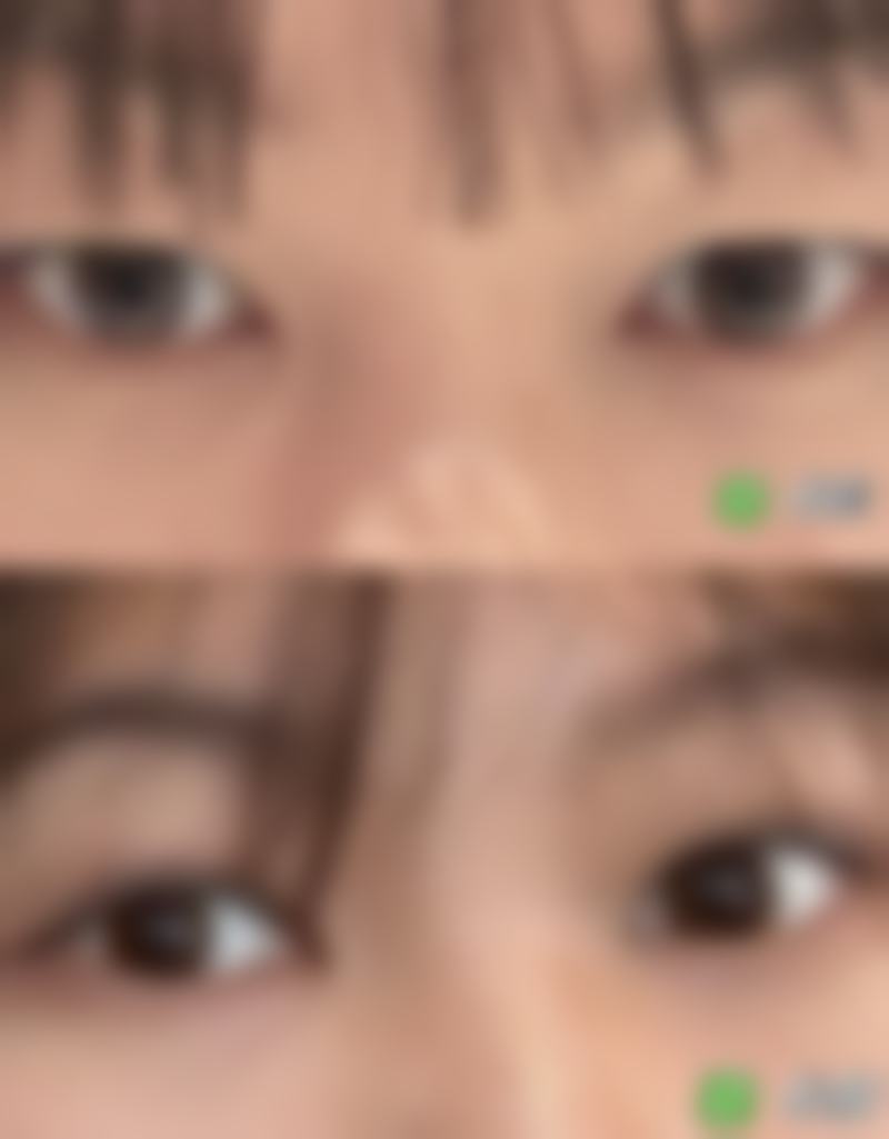 玻尿酸除皱针靠谱吗