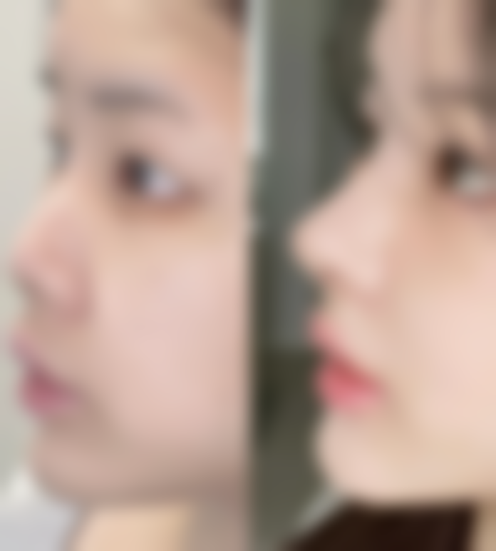 韩国休&美整形外科真实实例