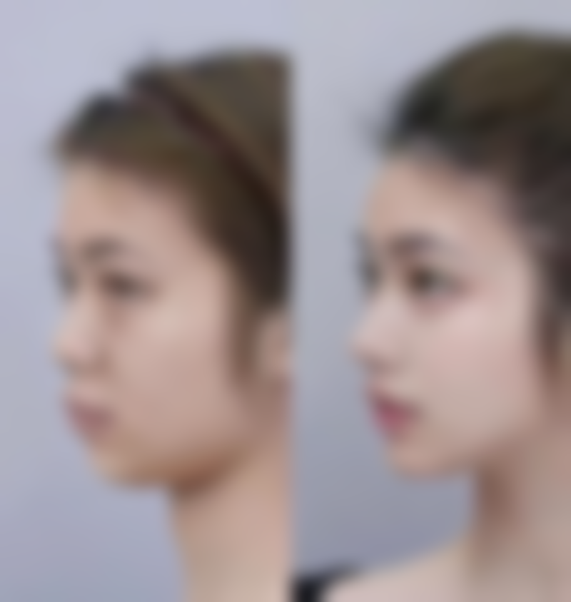 韩国罗然韩医减脂医院真实实例