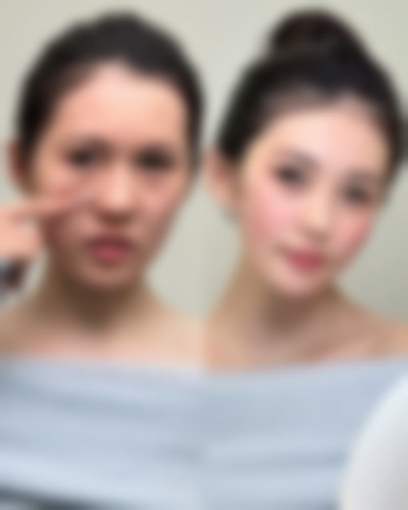 肉毒素除皱针怎么样