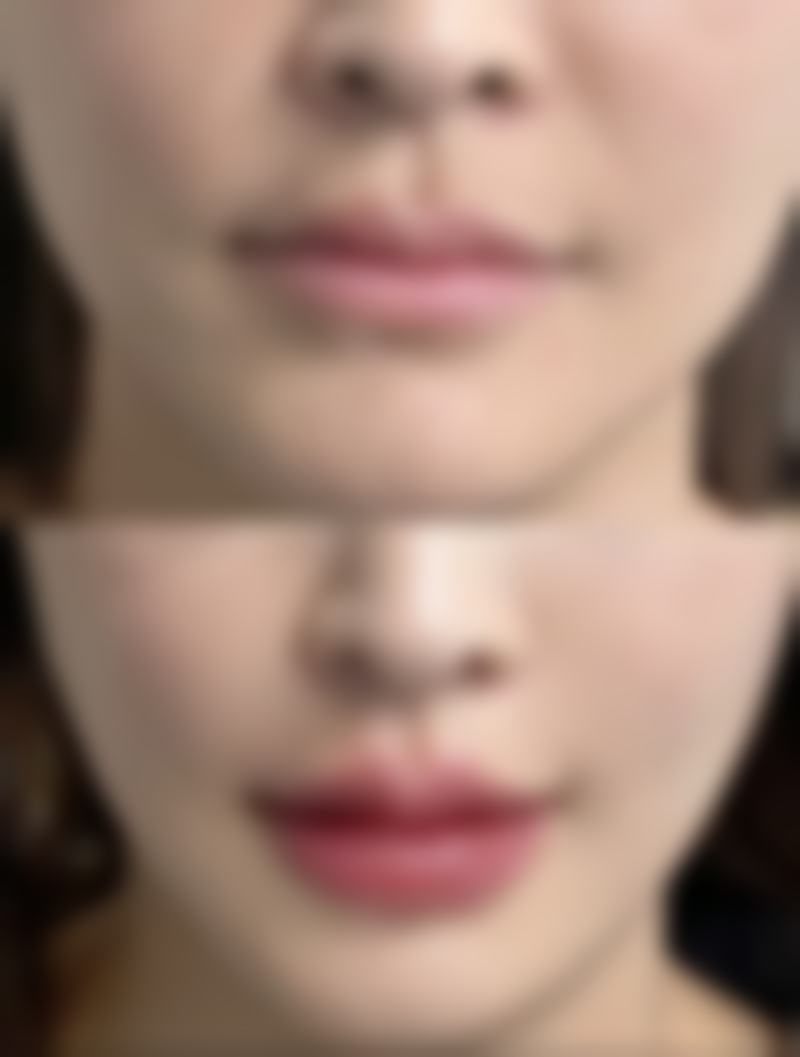 积极治疗能让三度烧伤疤痕修复加速吗