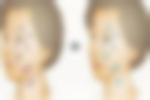 瘦下来眼袋明显适合做哪种医美项目