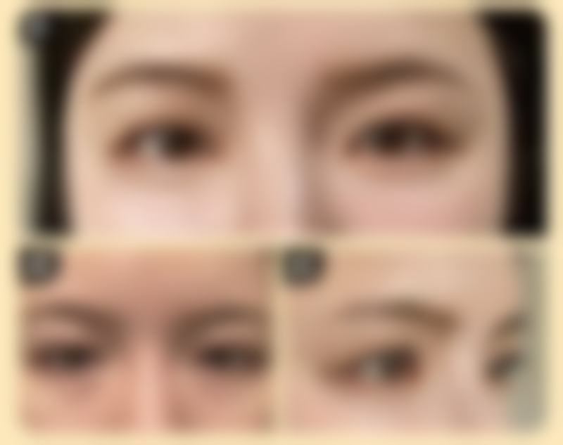 激光修复凹疤成效怎么样