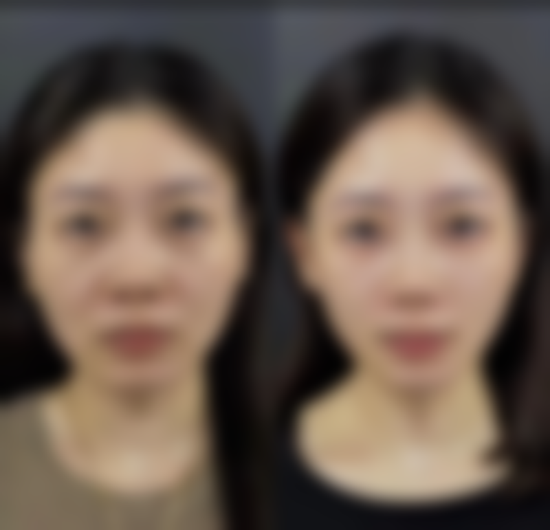 激光祛疤去除脸上黑疤痕靠谱吗