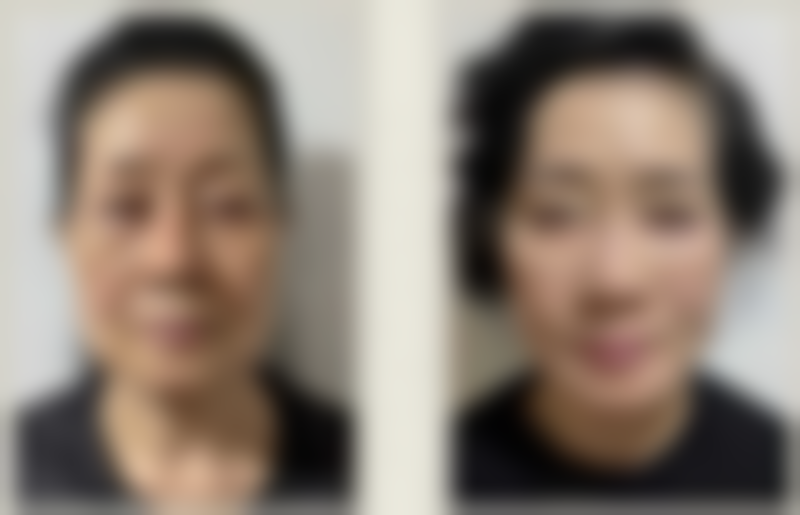 内切去眼袋适合减肥后有眼袋的人吗