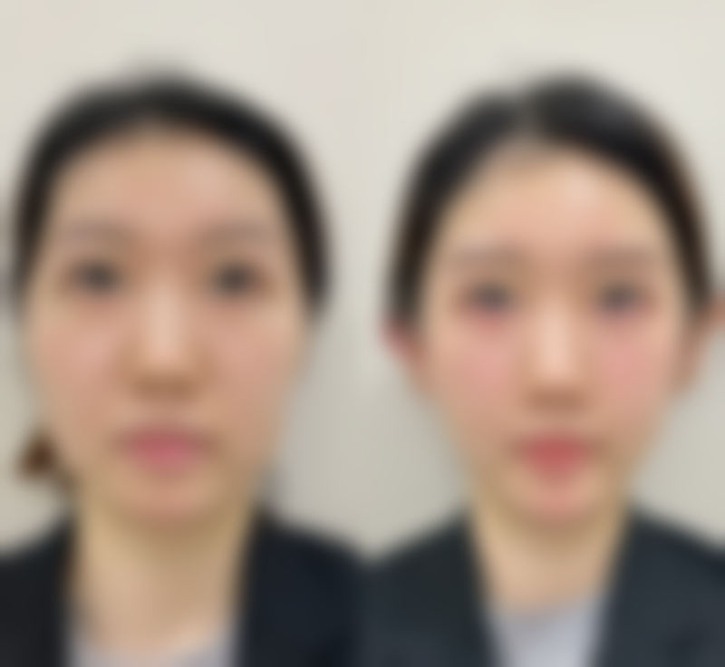 减肥后做内切去眼袋值不值