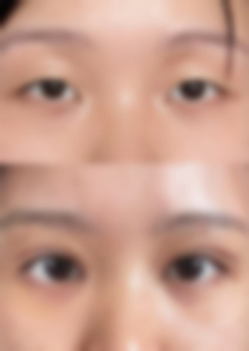 去除脸上黑疤痕后如何护理