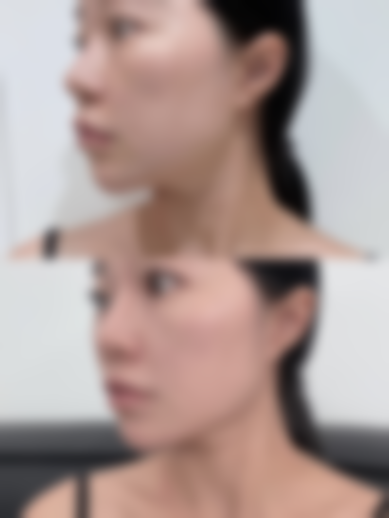 白毒瘦脸针和其他瘦脸针牌子对比怎么样