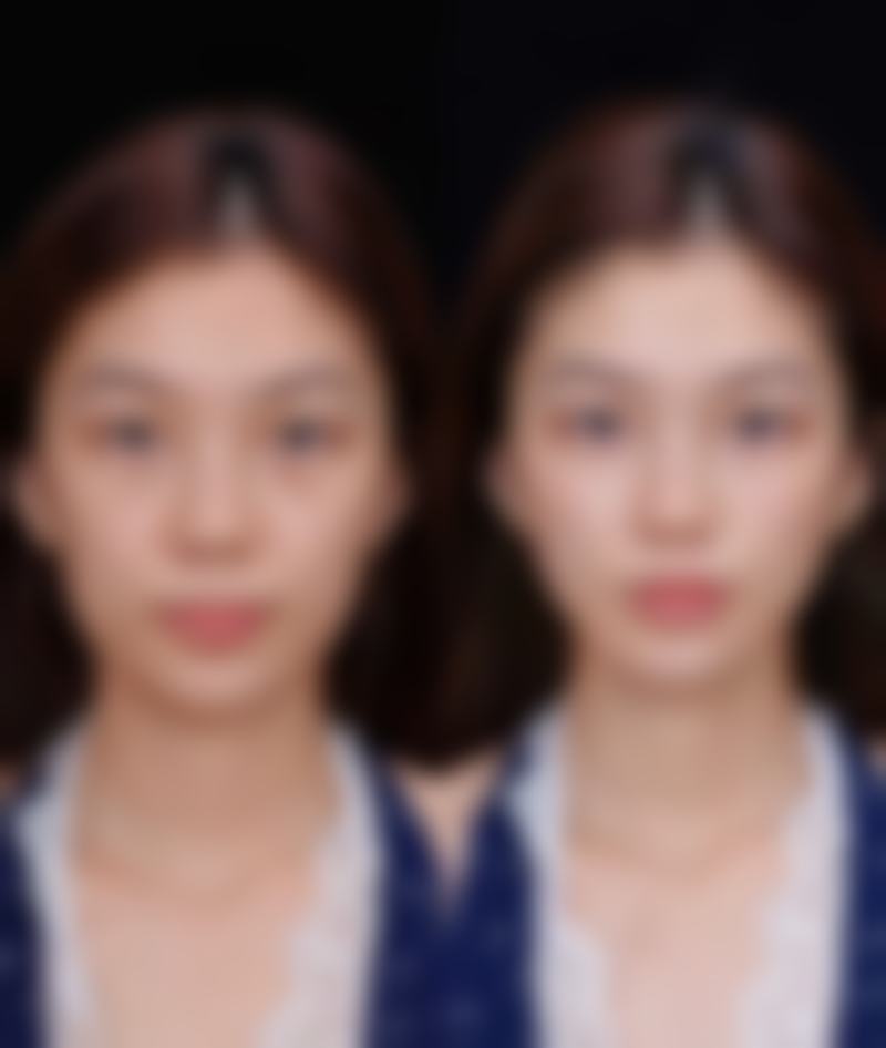 廊坊杨明勇医生真实实例：见证美丽蜕变