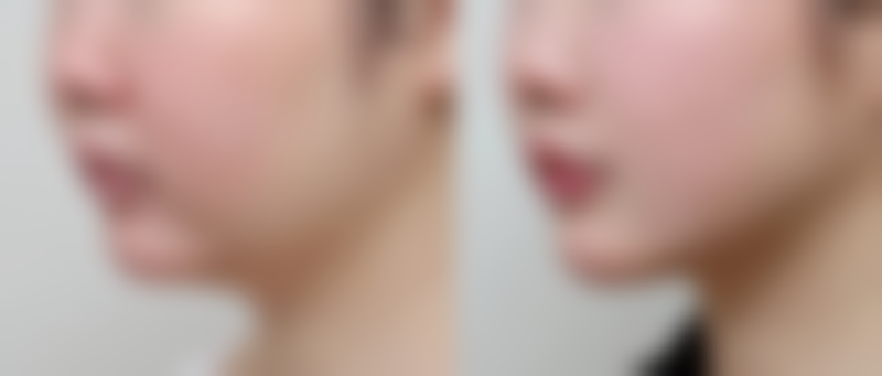 硅胶隆胸后喂奶值不值