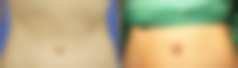 白色疤痕怎么变回去肉色？掌握医美微晶磨皮、激光祛疤方法，还你光滑美肌不再愁！ 