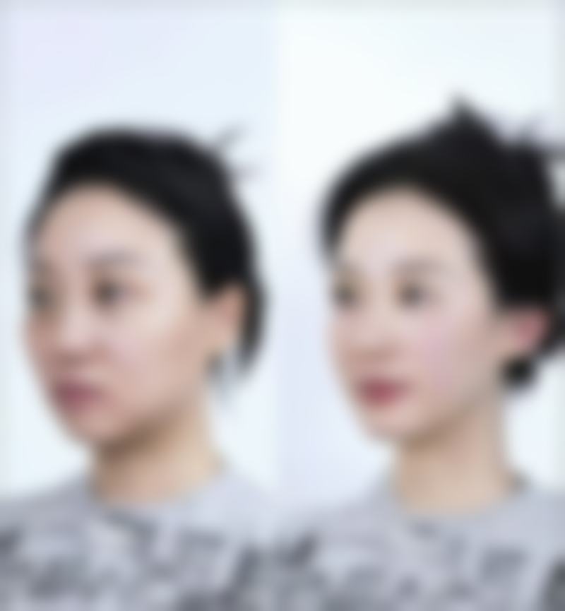 选对方法能避免割的双眼皮看起来假吗
