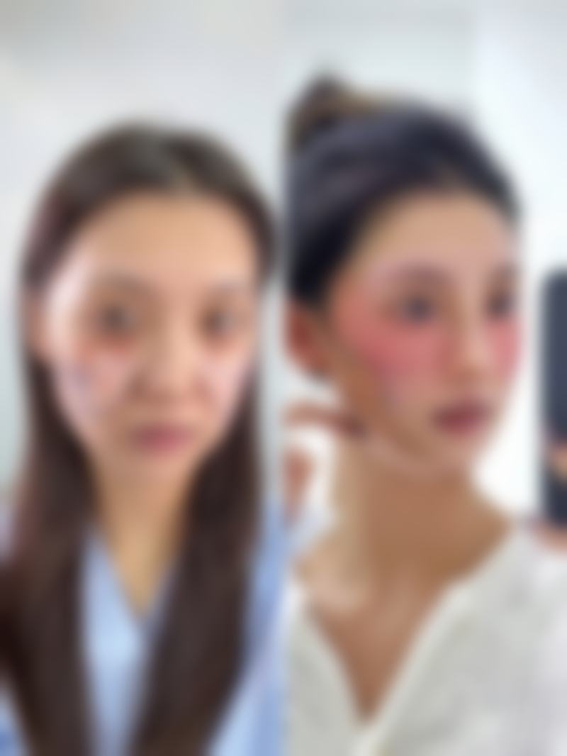 热熔无痕去眼袋让你年轻5岁值不值?