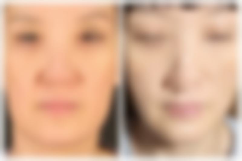 如何判断割双眼皮第二天是否适合坐飞机