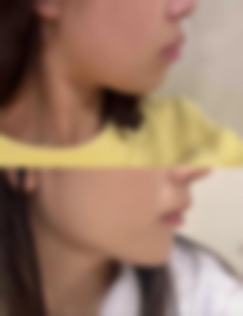 割双眼皮后坐飞机影响修复的概率大吗