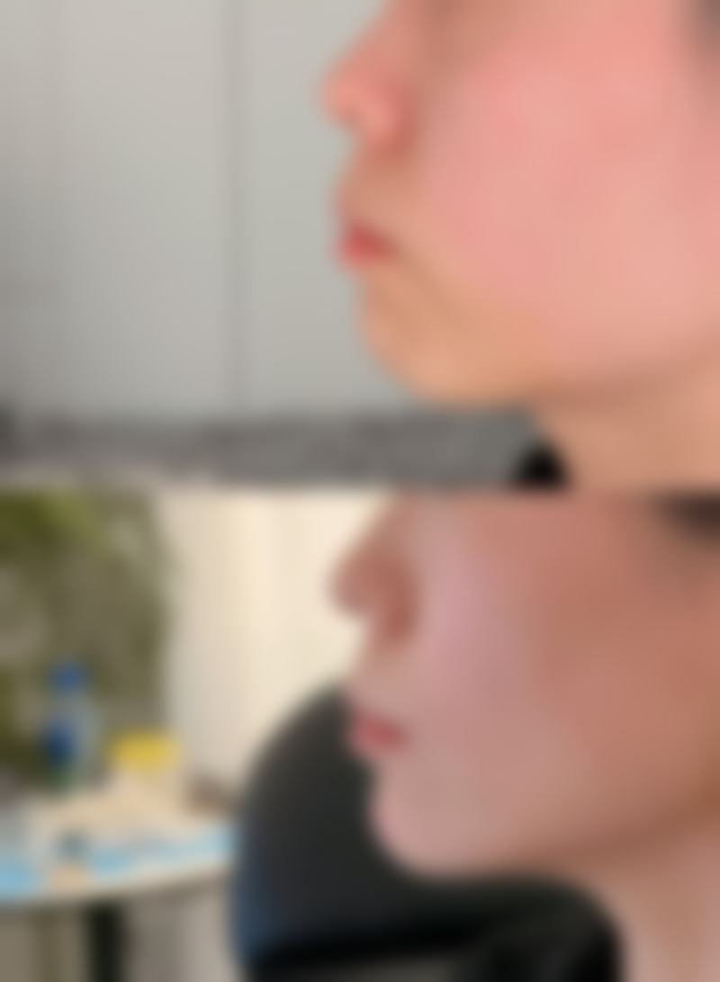 哪些因素会影响眼袋手术后外翻修复时间