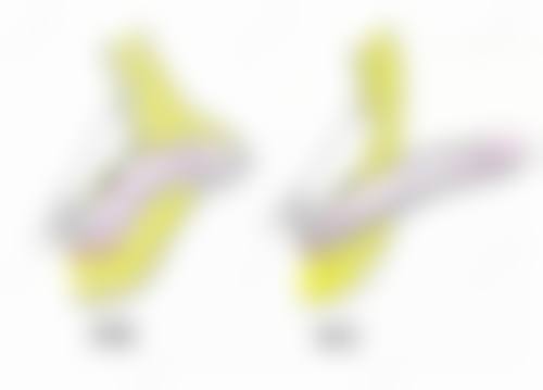 激光祛疤修复手上疤痕适合吗