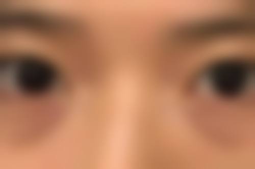 双眼皮疤痕增生什么时候消除？一般3-6个月可逐渐软化，1-2年基本能恢复自然！ 