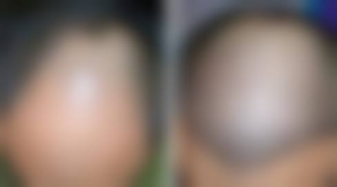 无锡市江阴首佳植发美容诊所真实实例