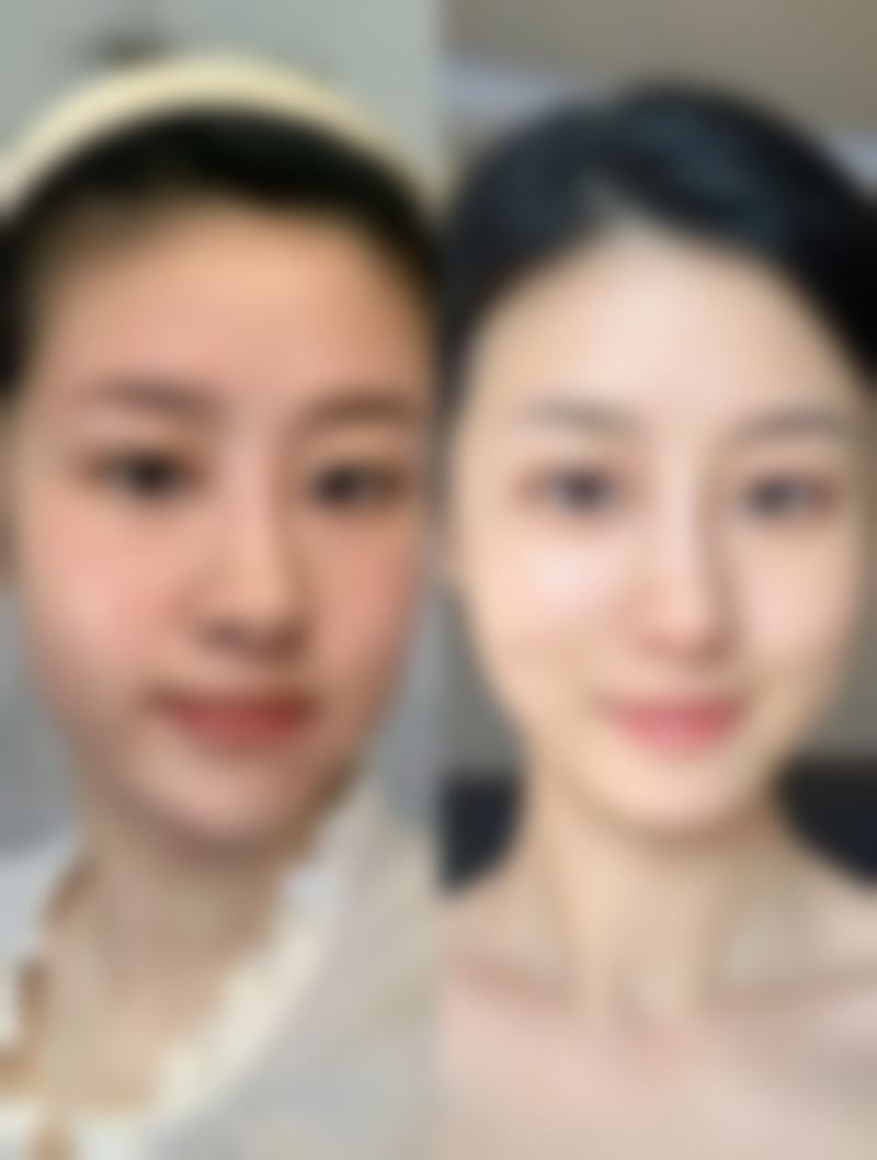 徐州心源整形医院真实实例