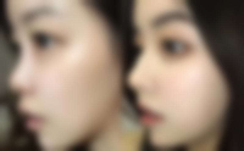 单眼皮突然变成双眼皮是怎么回事