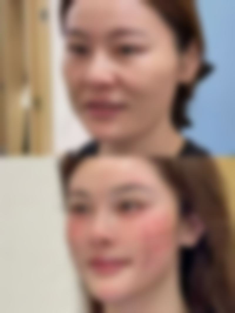 埋线双眼皮两只眼睛不一样修复成效怎么样