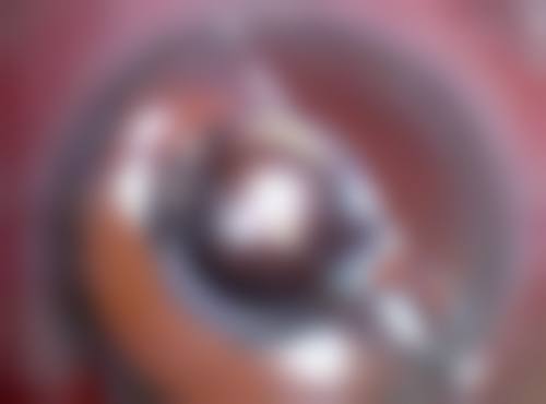 做完双眼皮疤痕修复时间受哪些因素影响