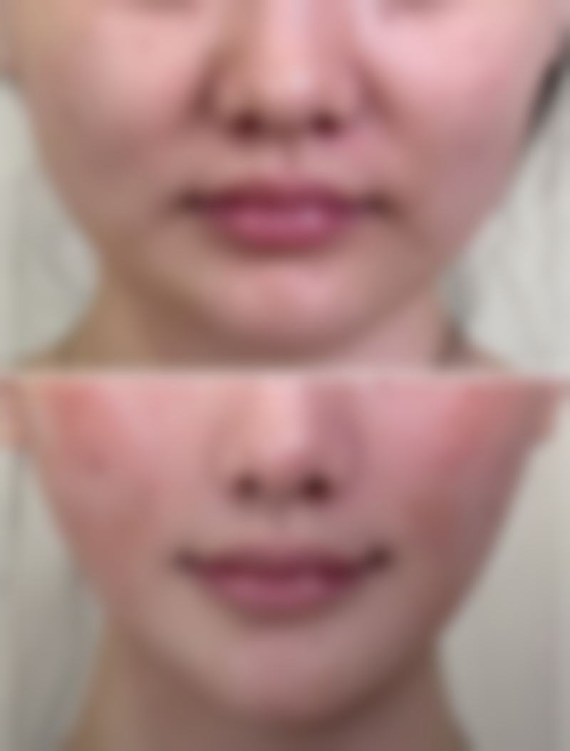 做完双眼皮后疤痕修复期间要注意什么