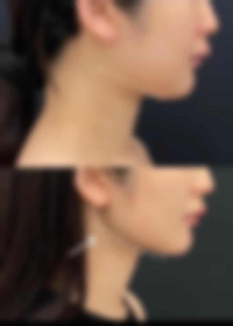 抽脂后加强锻炼适合吗