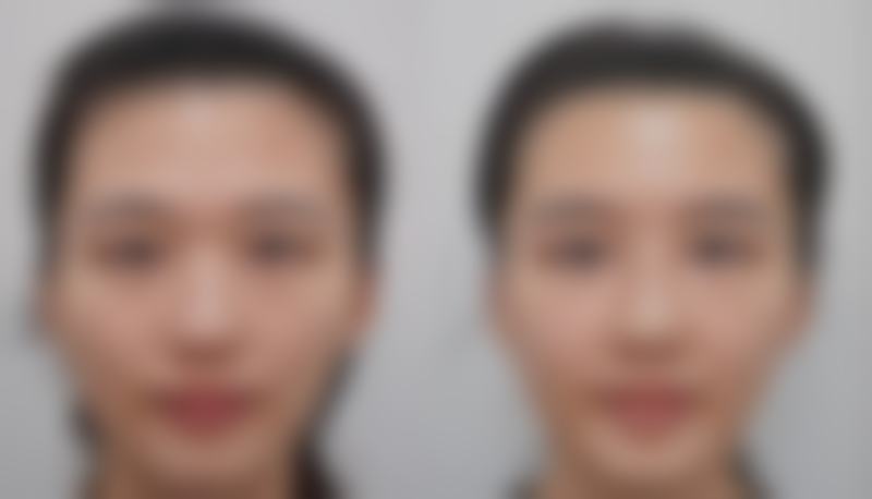 外切双眼皮修复期间如何护理