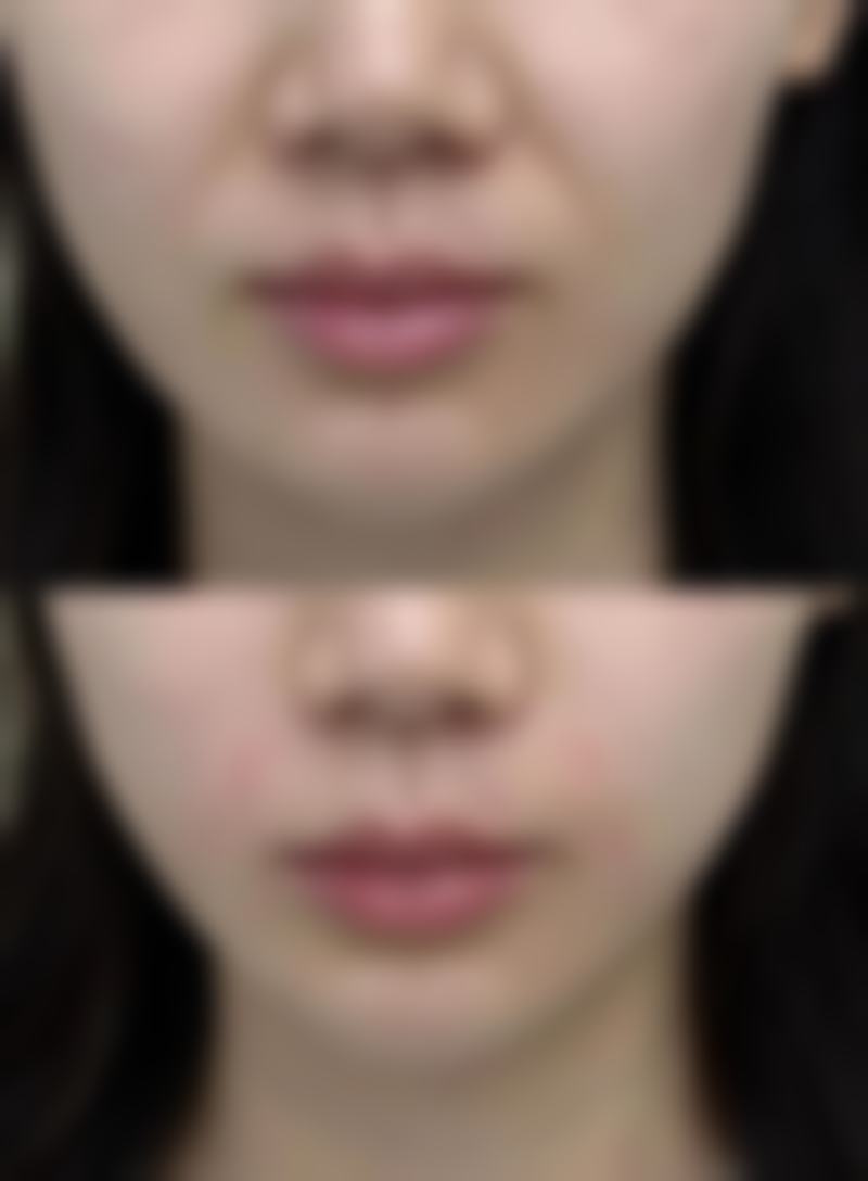选对双眼皮术式，成效好的关键因素有哪些