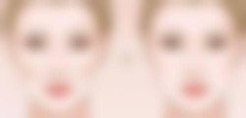 放射治疗预防鼻子术后疤痕增生适合吗?