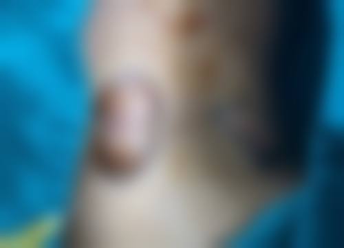 激光治疗点痣增生疤痕一次治疗靠谱吗