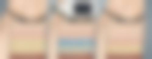 激光治疗点痣增生疤痕一次可以好吗？多数情况需多次，但部分小面积疤痕一次治疗或能显著改善！ 