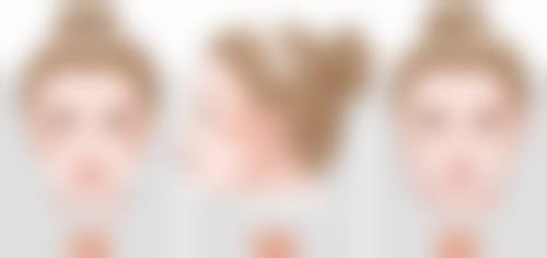 激光治疗点痣增生疤痕一次治疗后如何护理